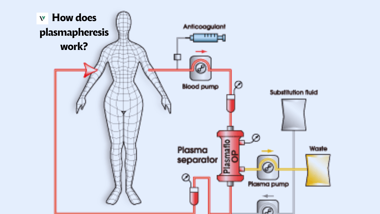 Plasmapheresis